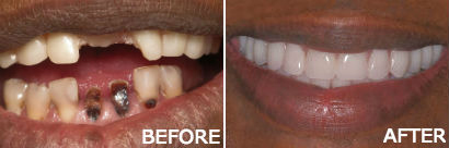 Dentures with Implants in Pleasantville NJ