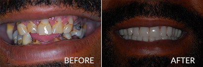 Dentures in Atlantic City