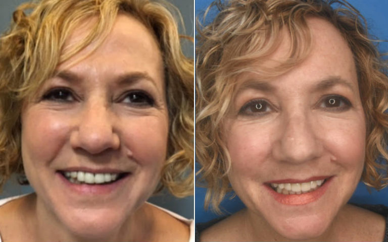 Porcelain Crowns Atlantic City