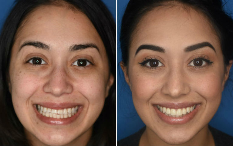 Porcelain Veneers Pleasantville NJ