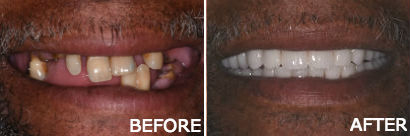 Dentures in Atlantic City