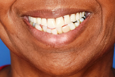 Pleasantville NJ Cosmetic Dentist