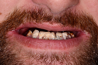 Pleasantville NJ Dentures