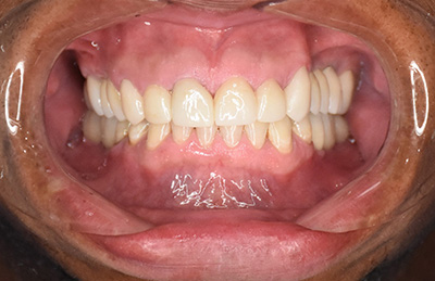 Full Mouth Reconstruction in Atlantic City