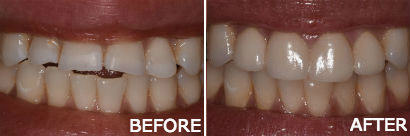 Porcelain Veneers in Pleasantville NJ
