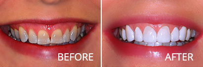 Dental Veneers Atlantic City