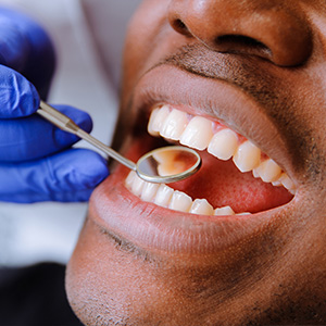 Emergency Dentist Pleasantville NJ